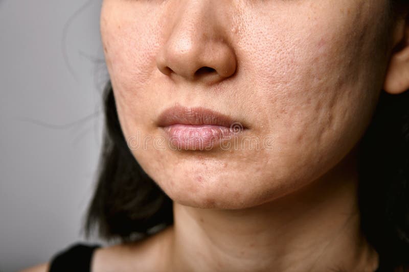 粉刺病皮肤问题与唇口干燥的女性近脸 免版税库存照片 粉刺病皮肤问题与唇口干燥的女性近脸 免版税库存照片