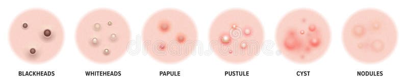 Acne types, skin pimples blackheads and face comedones. Vector icons of skin acne pimples, cosmetology and skincare problems. Acne types, skin pimples blackheads and face comedones. Vector icons of skin acne pimples, cosmetology and skincare problems