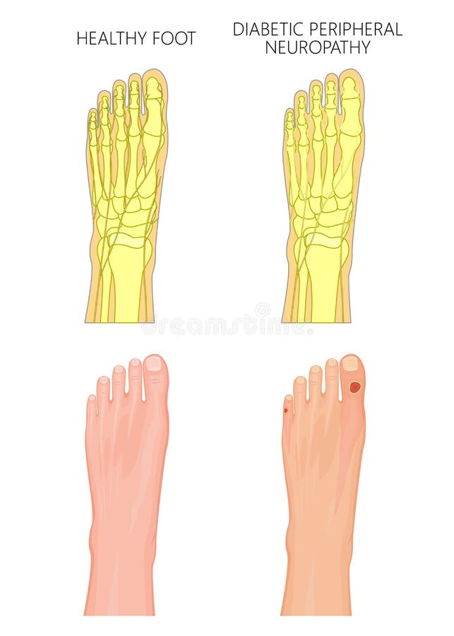 Illustration of Diabetic Peripheral Neuropathy. Healthy foot and foot with damaged nerves and ulcers on the toes. Used: transparency, gradient, blend mode. Illustration of Diabetic Peripheral Neuropathy. Healthy foot and foot with damaged nerves and ulcers on the toes. Used: transparency, gradient, blend mode.