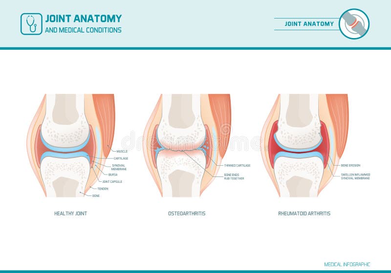 Joint anatomy, osteoarthritis and rheumatoid arthritis infographic with anatomical illustrations. Joint anatomy, osteoarthritis and rheumatoid arthritis infographic with anatomical illustrations