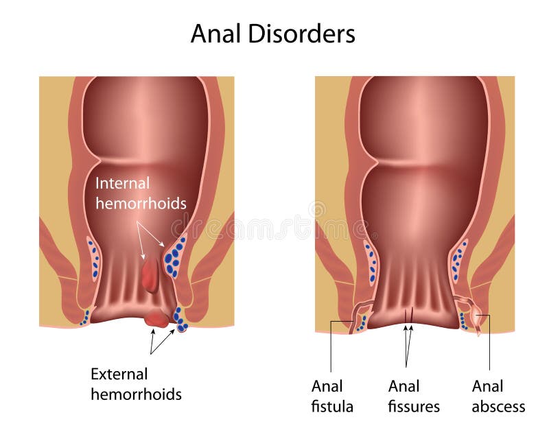 Hemorrhoids, anal fissures, abscess and fistula. Hemorrhoids, anal fissures, abscess and fistula