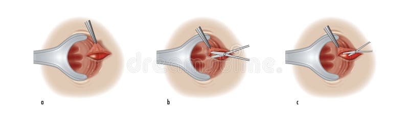 Drawing showing a surgeon cutting the internal anal sphincter muscle to aid in the healing of acute anal fissure. Drawing showing a surgeon cutting the internal anal sphincter muscle to aid in the healing of acute anal fissure