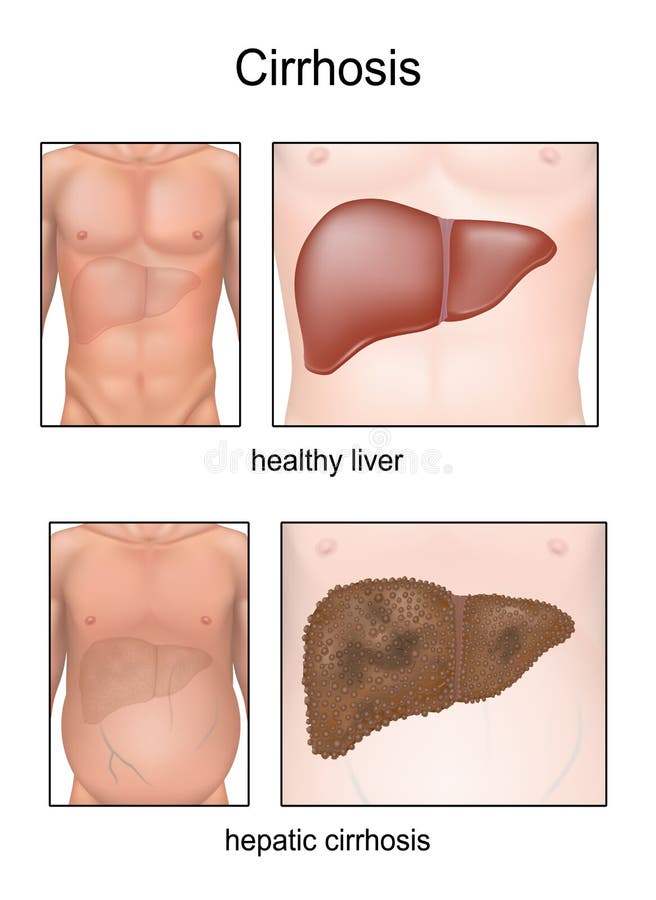 Cirrhosis. Liver disease illustration with liver condition, swelling belly symptom and comparison between healthy liver and cirrhotic liver. Cirrhosis. Liver disease illustration with liver condition, swelling belly symptom and comparison between healthy liver and cirrhotic liver