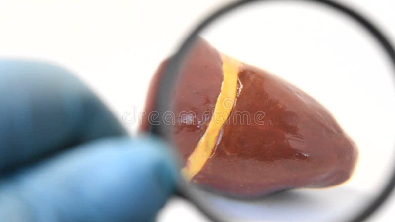 肝硬化、结石性腺胆囊病人肝、肝系统体的诊断. 医生放大镜 股票视频