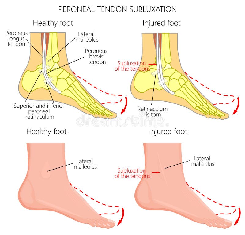 Vector illustration of Peroneal Tendon Injuries. Peroneal tendon dislocation or subluxation when the superior peroneal retinaculum or retinacula is torn. Lateral ankle injury. Vector illustration of Peroneal Tendon Injuries. Peroneal tendon dislocation or subluxation when the superior peroneal retinaculum or retinacula is torn. Lateral ankle injury.