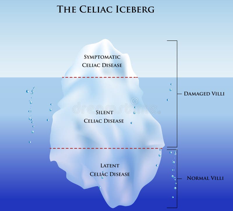 Celiac disease Iceberg. Symptomatic, Silent and Latent celiac disease. Celiac disease Iceberg. Symptomatic, Silent and Latent celiac disease.