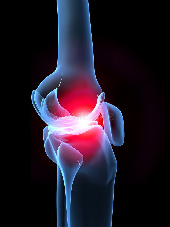 3d rendered illustration of a x-ray knee with pain. 3d rendered illustration of a x-ray knee with pain