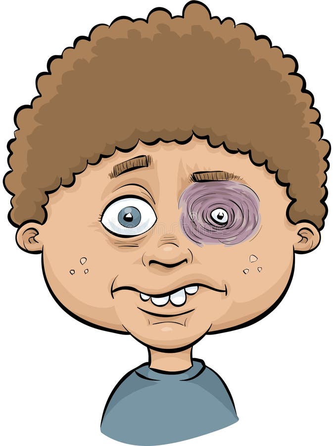 A cartoon boy with a painful, swollen black eye. A cartoon boy with a painful, swollen black eye.