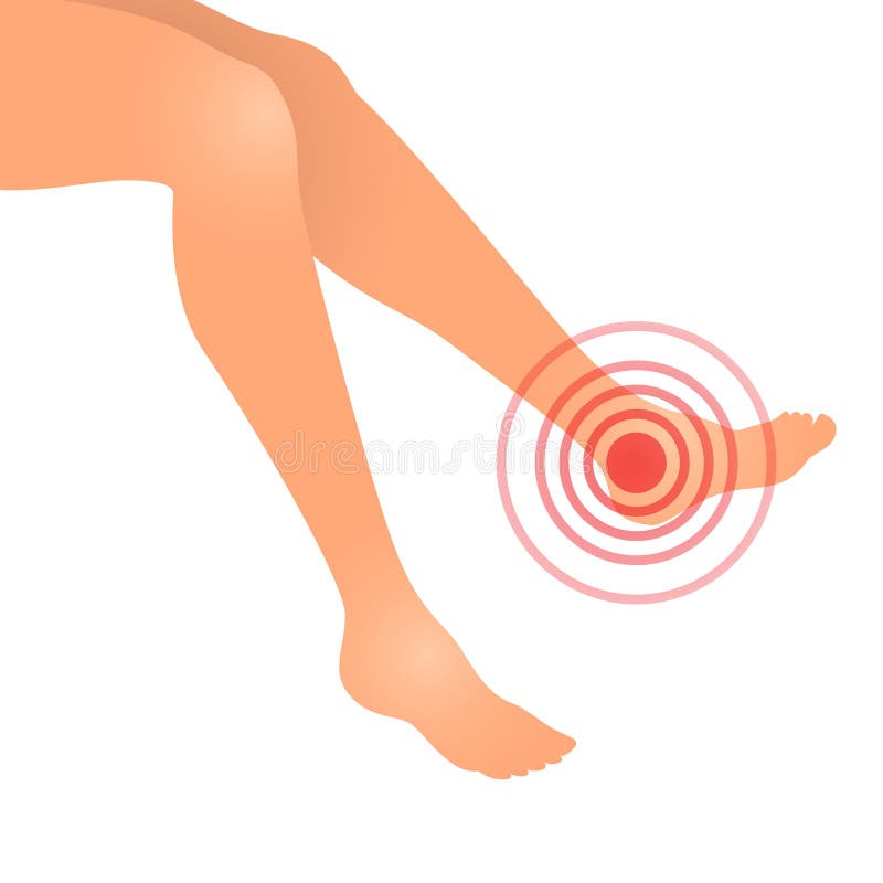 Vector illustration of woman feet swollen or feet pain. Vector illustration of woman feet swollen or feet pain