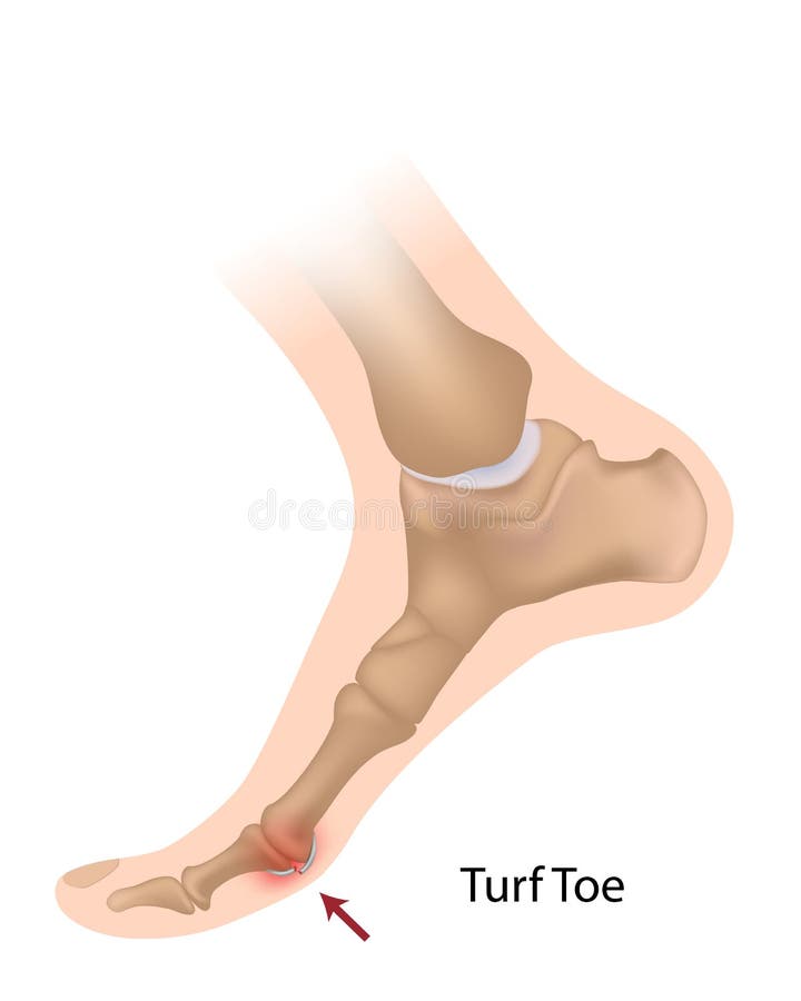 Sprain or tears of ligaments of the big toe joint, a common sport injury, eps10. Sprain or tears of ligaments of the big toe joint, a common sport injury, eps10