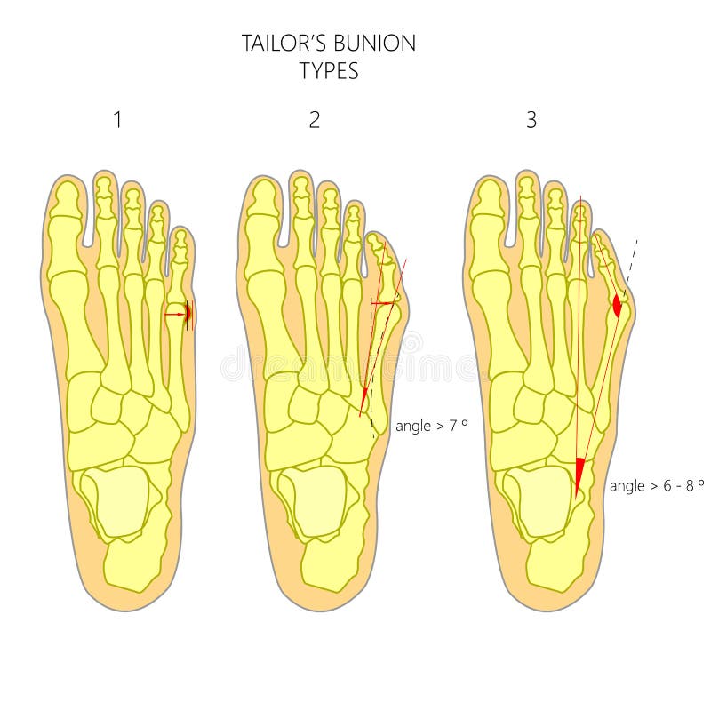 Diagnosis of the tailor's bunion with angles of deviation. Diagnosis of the tailor's bunion with angles of deviation.