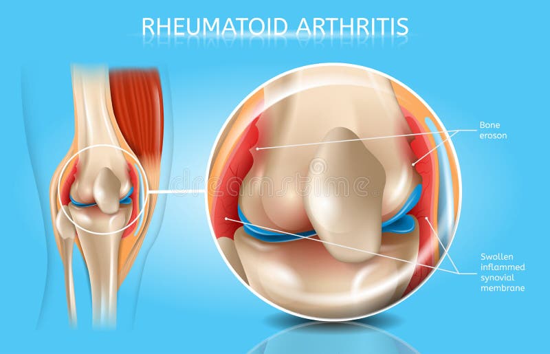 Rheumatoid Arthritis Realistic Vector Anatomical Chart With Magnified Inflamed And Swollen Synovial Membrane, Bone Erosion In Human Joint Illustration. Musculoskeletal System Disease Medical Poster. Rheumatoid Arthritis Realistic Vector Anatomical Chart With Magnified Inflamed And Swollen Synovial Membrane, Bone Erosion In Human Joint Illustration. Musculoskeletal System Disease Medical Poster