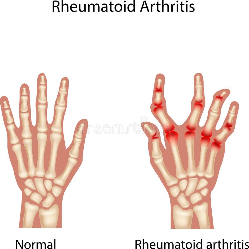 Illustration of Rheumatoid Arthritis on white background. Illustration of Rheumatoid Arthritis on white background