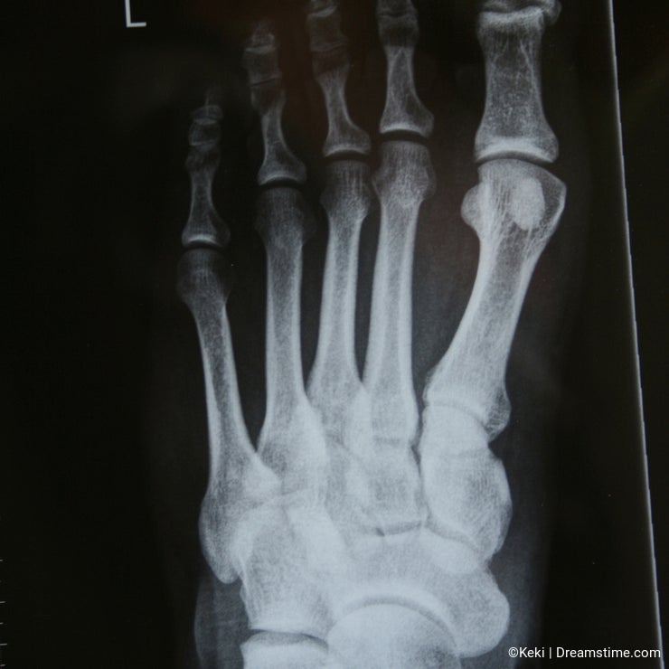 XRAY of a foot