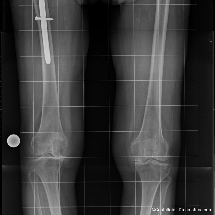 X-ray image of lower body