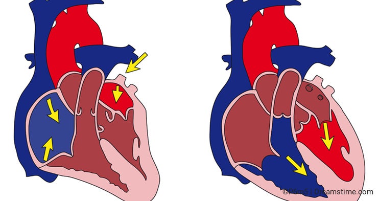 Ductus arteriosus1