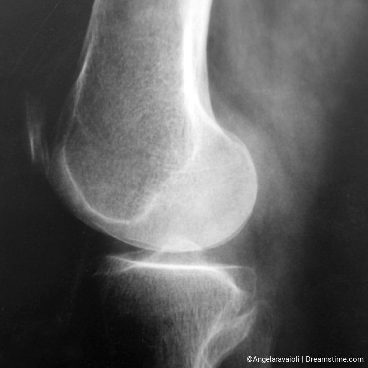 Knee x-ray