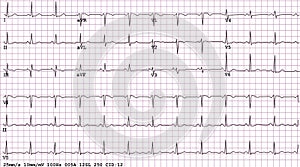 12-lead Electrocardiogram