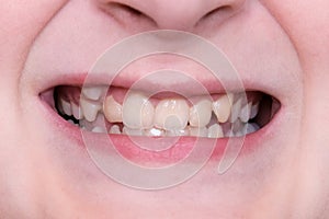 A 12 year old teeth with malocclusion close up, orthodontic problem and preparing for treatment, crooked teeth before