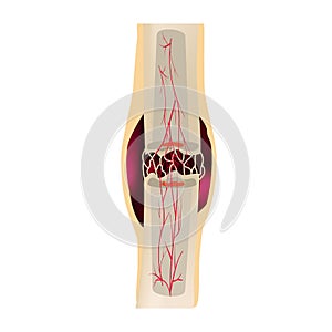 2 Stage Of Healing Bone Fracture. Formation of callus. The bone fracture. Infographics. Vector illustration on isolated