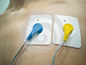 24-hour ECG recording. Holter monitoring. Blue and yellow Holter sensors - heart with Ukraine