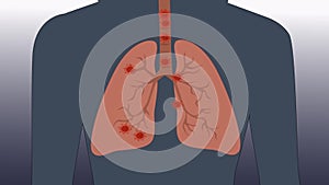 2d animation of coronavirus bacteria spreading in lungs of young woman. Concept of viral transmissible infectious Covid