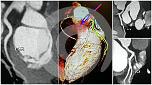3D angio tomography heart lcx artery collage