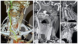 3D angio tomography right internal carotid artery collage