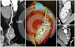 3D angio tomography scan of lad heart collage