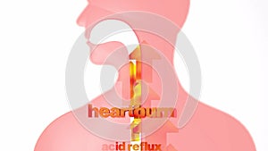 3d animation of digestive system with gastric reflux and heartburn.