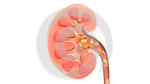 3D animation of kidney interior isolated with stone.