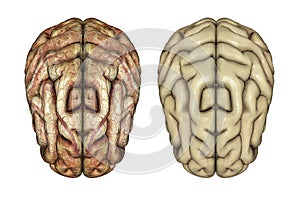 3D healthy and diseased brains