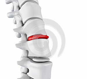 3d Herniated disk concept