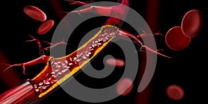 3d illustration of Blocked blood vessel - artery with cholesterol buildup realistic