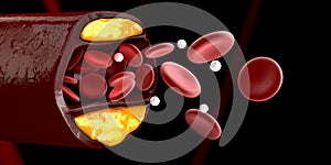 3d Illustration of blood cells with plaque buildup of cholesterol  black