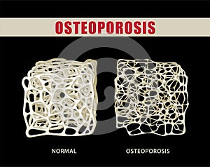 3D illustration comparing osteoporosis with normal bone on black background