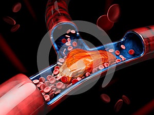 3d Illustration of Deep Vein Thrombosis or Blood Clots. Embolism