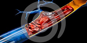 3d Illustration of Deep Vein Thrombosis or Blood Clots. Embolism, clipping path included.
