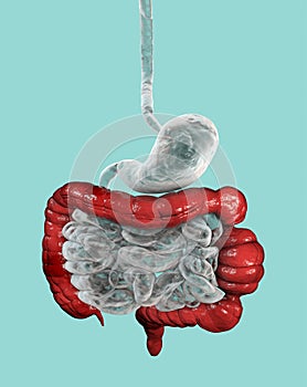 A 3D illustration depicting the large bowel with highlighted spasms, showcasing the characteristic feature of irritable