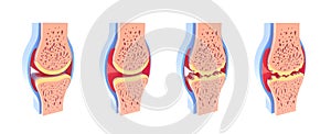 3d illustration of healthy and spherical synovial joint.