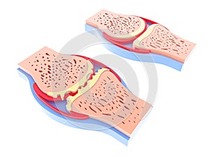 3d illustration of healthy synovial joint and with osteoarthritis.