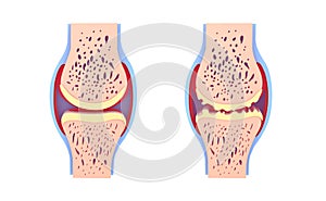 3d illustration of healthy synovial joint and with osteoarthritis.