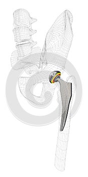 3d Illustration of Hip joint replacement, isolated gray