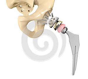 3D illustration of Hip replacement implant installed in the pelvis bone