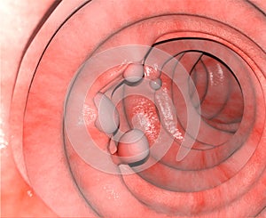 3d illustration of the intestinal polyps