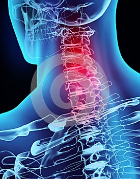 3D illustration x-ray neck painful.