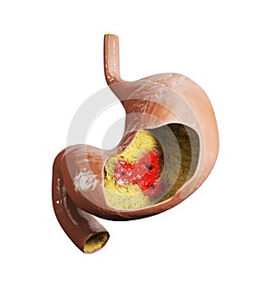 3d illustration of Stomach ulcer, human stomach anatomy