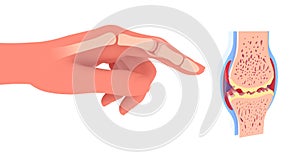 3d illustration of synovial joint with osteoarthritis.