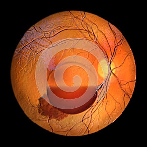 A 3D illustration of Terson syndrome, revealing intraocular hemorrhage observed during ophthalmoscopy