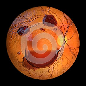 A 3D illustration of Terson syndrome, revealing intraocular hemorrhage observed during ophthalmoscopy